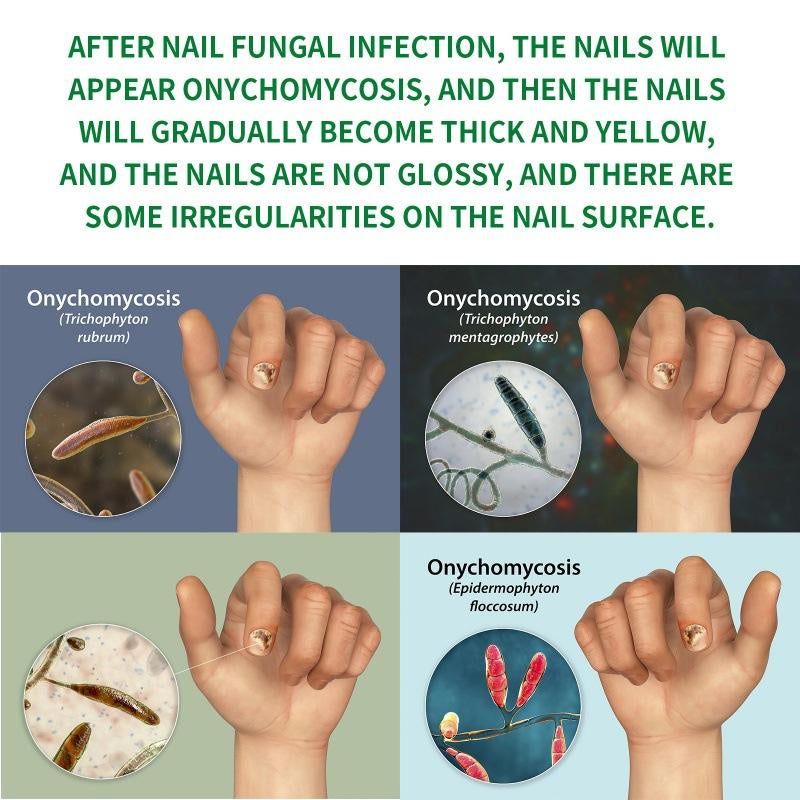 Ginger Nail Care, Nail Growth & Repair for Discolored & Damaged Toenails – Dermatologist-Tested, 1.0 Fl. Oz
