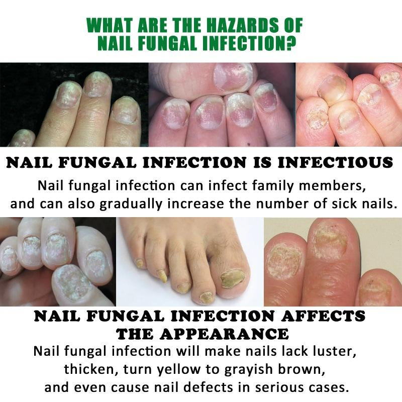 Ginger Nail Care, Nail Growth & Repair for Discolored & Damaged Toenails – Dermatologist-Tested, 1.0 Fl. Oz