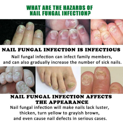 Ginger Nail Care, Nail Growth & Repair for Discolored & Damaged Toenails – Dermatologist-Tested, 1.0 Fl. Oz